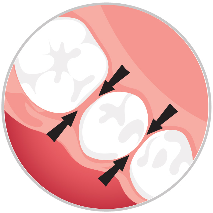 Illustration of teeth indicating the interdental spaces